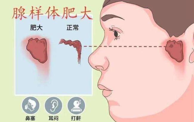腺樣體肥大能自愈嗎？——深度解析與理解，腺樣體肥大能否自愈？全面深度解析