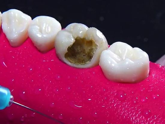 牙齒疼痛，如何應對牙爛大窟窿帶來的困擾，牙齒爛大窟窿引發(fā)疼痛，應對方法解析