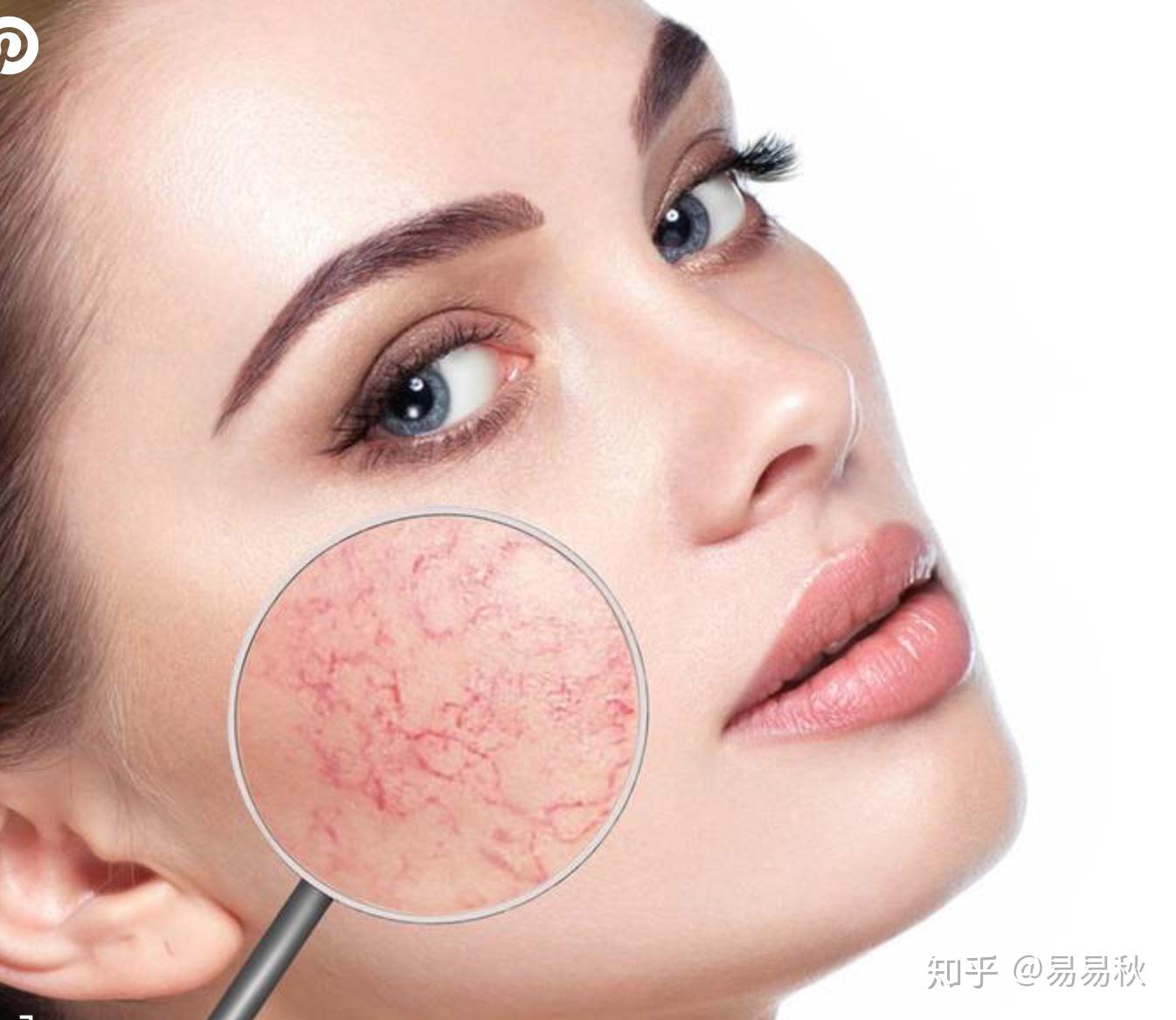 改善面部紅血絲的方法，改善面部紅血絲的有效方法