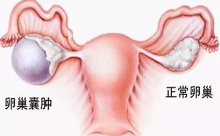 卵巢囊腫的十個征兆，卵巢囊腫的十個征兆解析