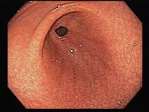 淺表性胃炎的癥狀及其影響，了解、預防與治療，淺表性胃炎的癥狀、影響、預防與治療全解析