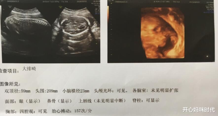 四維彩超下的睪丸，探索與理解，四維彩超下的睪丸，深入探索與理解