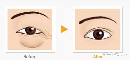 尋找最佳的眼袋治療醫(yī)院，專業(yè)解析與推薦，專業(yè)解析眼袋治療醫(yī)院推薦，助您尋找最佳治療機(jī)構(gòu)