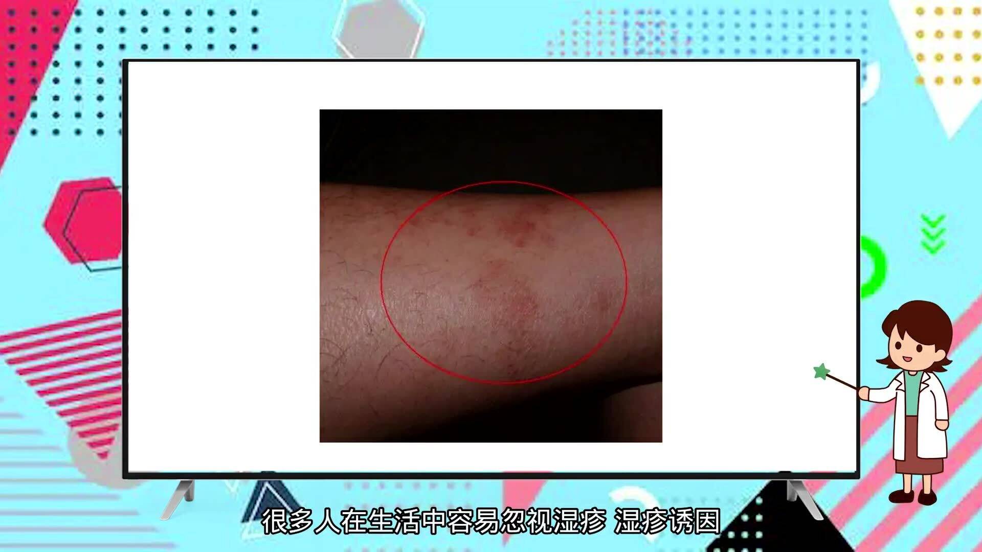 蕁麻疹夜晚止癢妙招，讓你遠離瘙癢困擾，蕁麻疹夜晚止癢小妙招，告別瘙癢煩惱