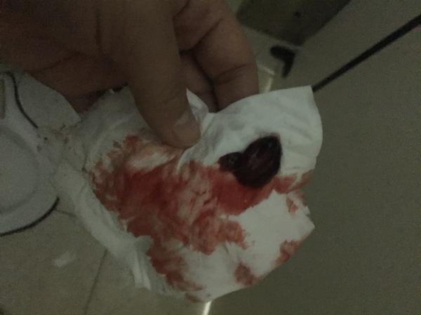 自然流產(chǎn)后的清宮問題解析——自己流掉了需要清宮嗎？，自然流產(chǎn)后需清宮嗎？——深度解析清宮問題疑慮！