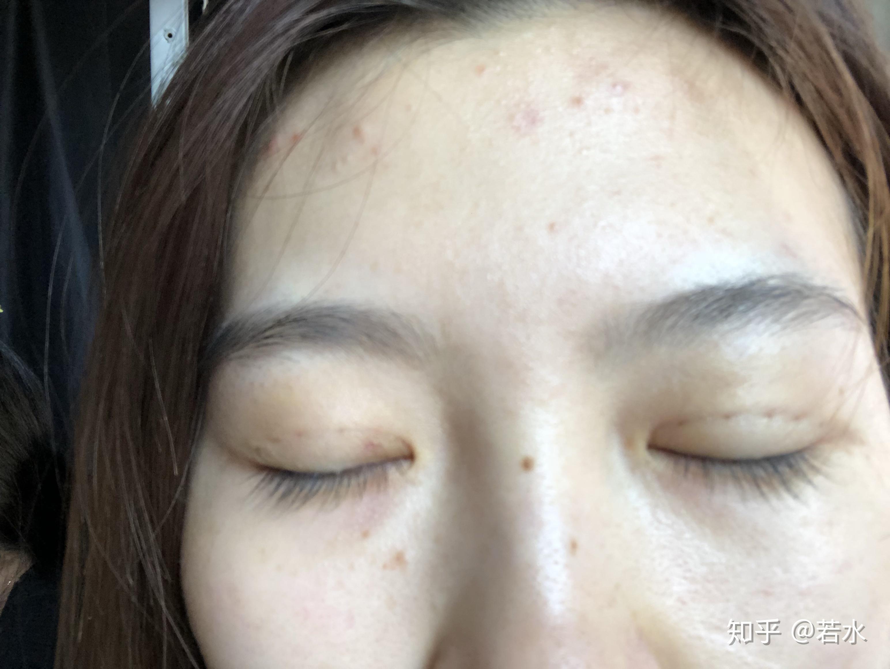 雙眼皮埋線手術(shù)效果持久性解析，持續(xù)時(shí)間與影響因素探討，雙眼皮埋線手術(shù)的持久性與影響因素深度解析