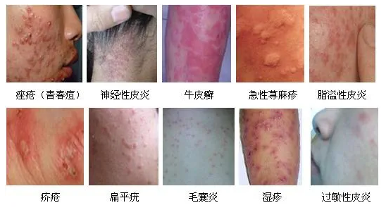 神經(jīng)性皮炎藥物治療指南，探尋最佳用藥方案，神經(jīng)性皮炎藥物治療指南，探尋最佳用藥方案及策略