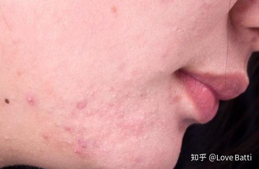 如何判斷臉上是否有螨蟲，全面解析與應(yīng)對(duì)建議，全面解析，如何判斷臉上是否有螨蟲及應(yīng)對(duì)建議