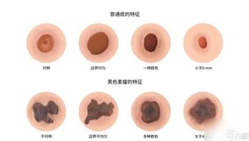 正常痣與黑色素瘤圖片，了解二者的區(qū)別與識(shí)別方法，正常痣與黑色素瘤圖片對(duì)比，區(qū)分與識(shí)別方法指南