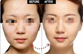 全面解析，瘦臉針價格及其相關(guān)因素，全面解析瘦臉針價格及其相關(guān)影響因素