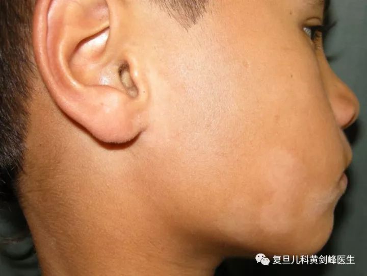 白色糠疹，了解、預(yù)防與治療，白色糠疹，全面解析、預(yù)防與治療方法